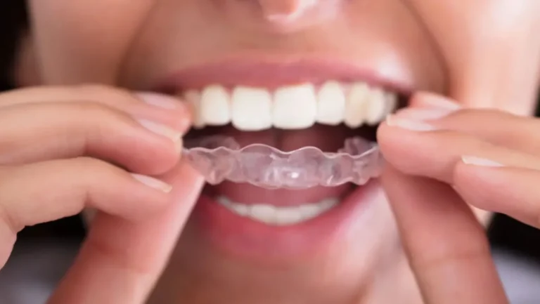 How Effective Invisalign Treatment Feels for Adults Over 30 in Surrey 
